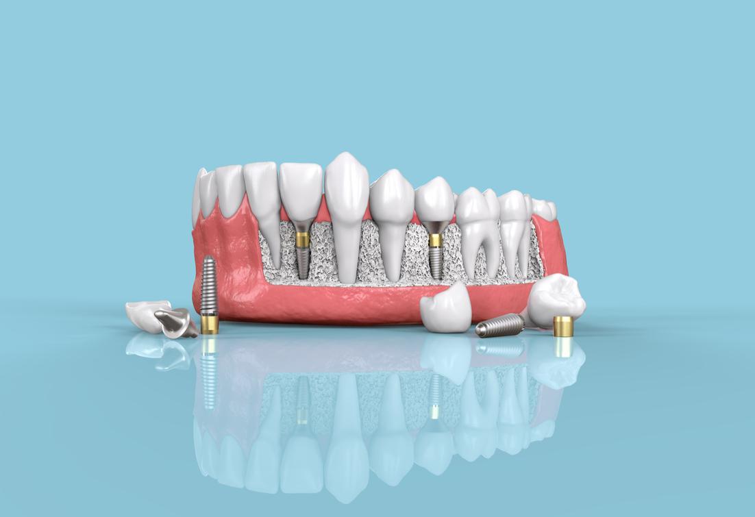 Dental Implants Wellesley, MA